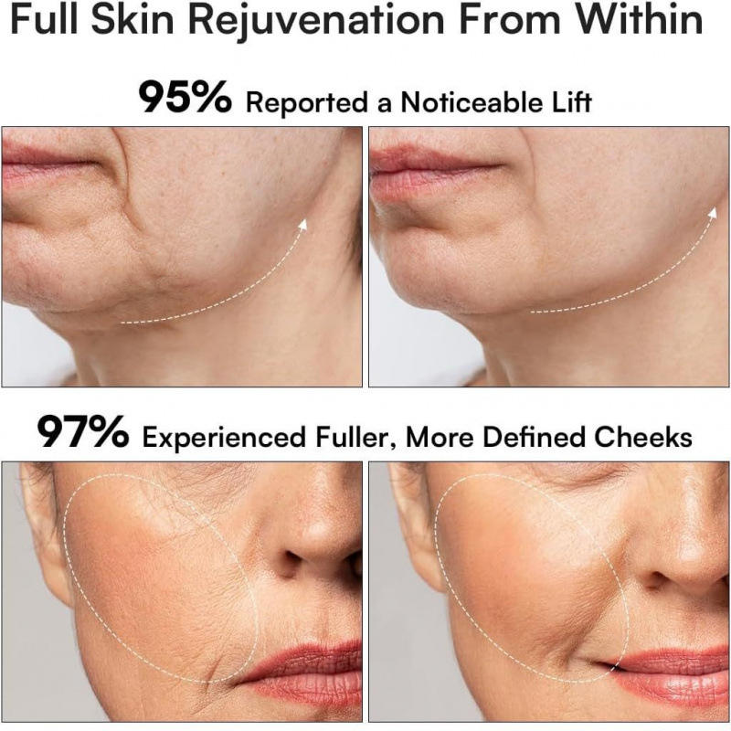 Wellness United RF Facial Lifting &amp; Skin Rejuvenation Device